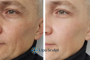 How to Fight Aging Symptoms 3 Fight Aging Symptoms Newmarket With HIFU and Morpheus8 Today!