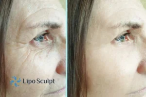 How to Fight Aging Symptoms 2 Do you want to Fight Aging Symptoms Newmarket? Contact Lipo Sculpt today!