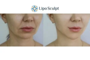 Explaining Total Skin Tightening Treatment And What It Can Do For You 2 Do you want to boost your self confidence? Give Morpheus8 Newmarket a try today!