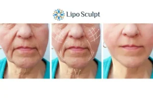 Explaining Total Skin Tightening Treatment And What It Can Do For You 3 Boost your confidence with Morpheus8 Newmarket call our team today!