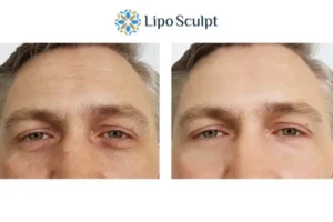 Explaining Total Skin Tightening Treatment And What It Can Do For You 6 Morpheus8 Newmarket book in today to find out more!