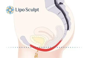 Pelvic Floor Chair Therapy 1 Pelvic Floor Chair Therapy Newmarket to treat incontinence.